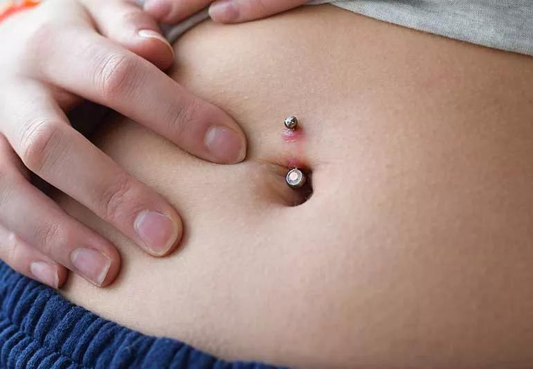 Infected Belly Button Piercing 1443971731 770x533 1 jpg