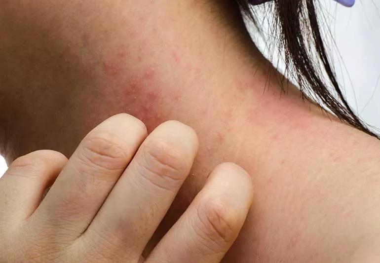 Lifestyle Changes Atopic Dermatitis 180934156 770x533 1 jpg