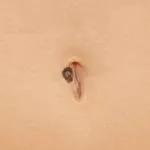 Navel Melanoma