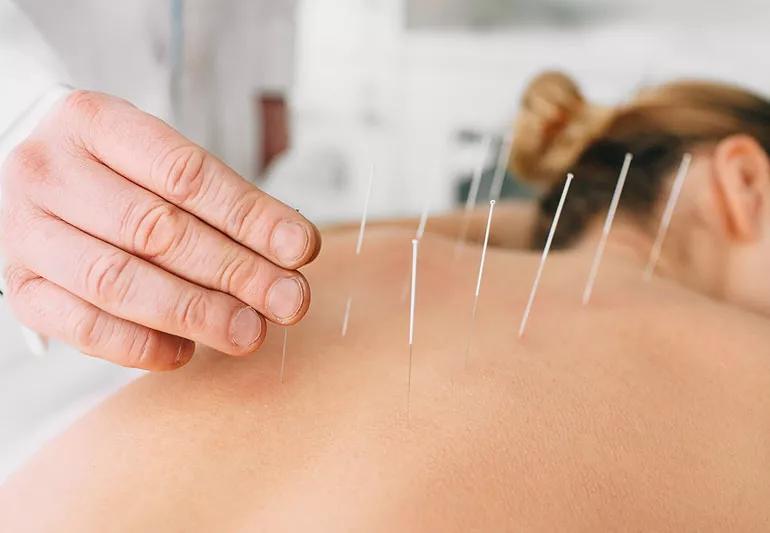 accupuncture 1126093074 770x533 1 jpg