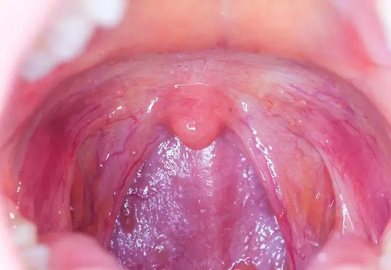 throat 815806282 1 jpg